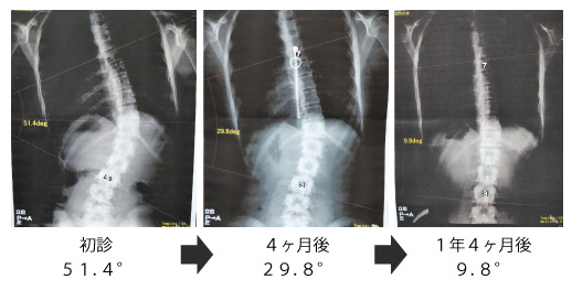 症例１中学２年女子